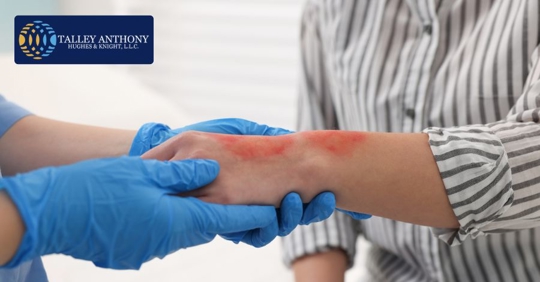 burn injury being treated